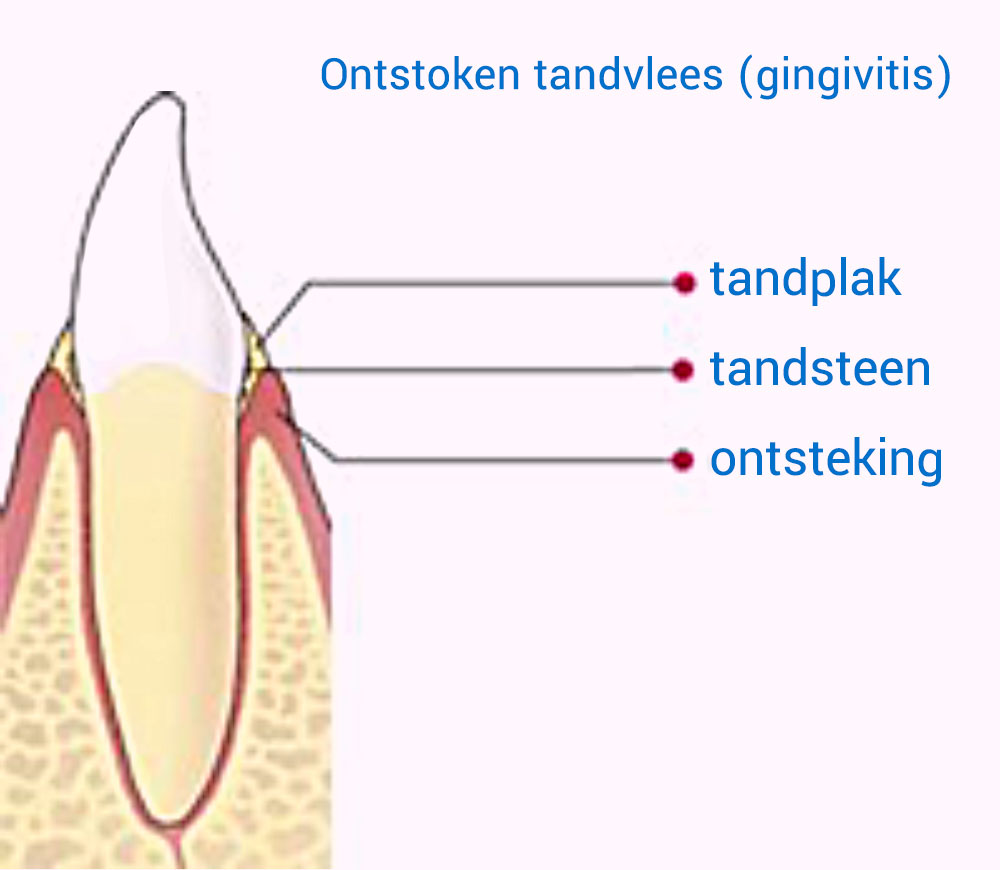 Ontstoken tandvlees (gingivitis)