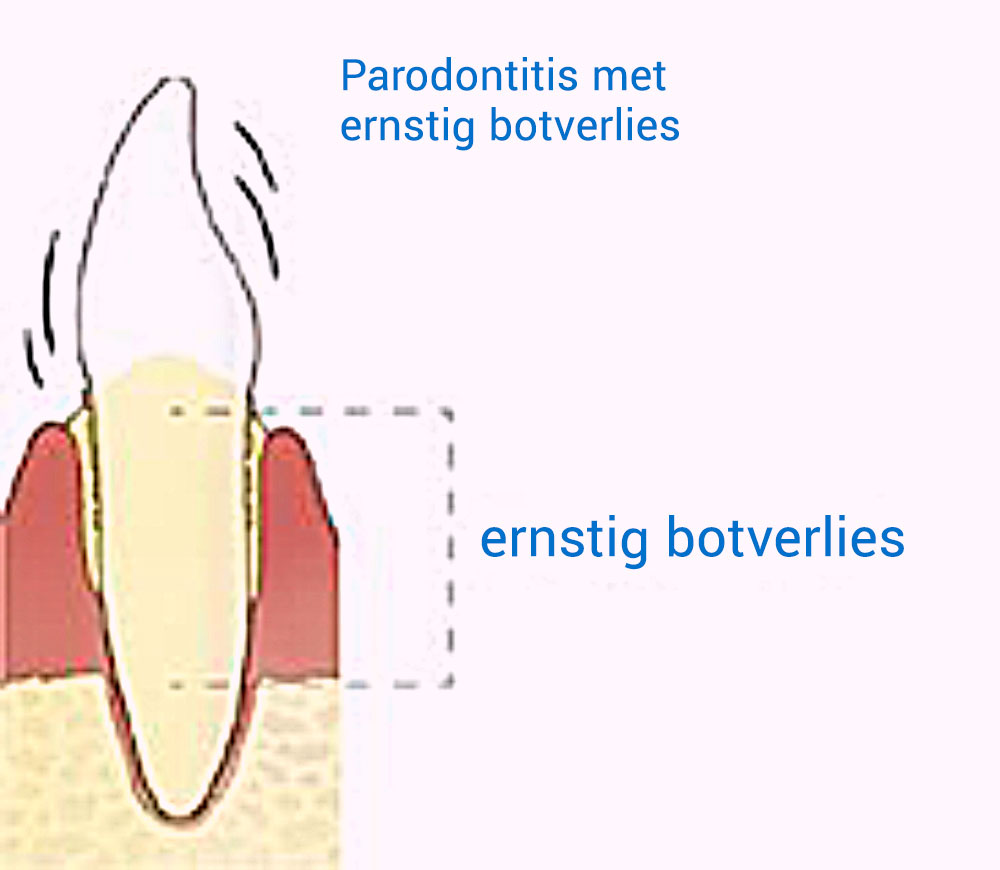Parodontitis met ernstig botverlies