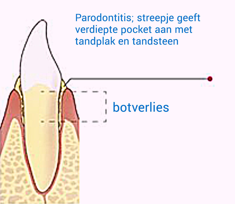 Parodontitis; streepje geeft verdiepte pocket aan met tandplak en tandsteen